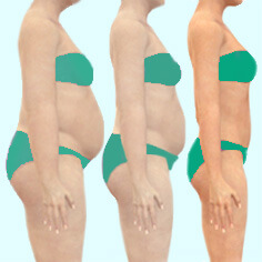 Weight Loss Surgery